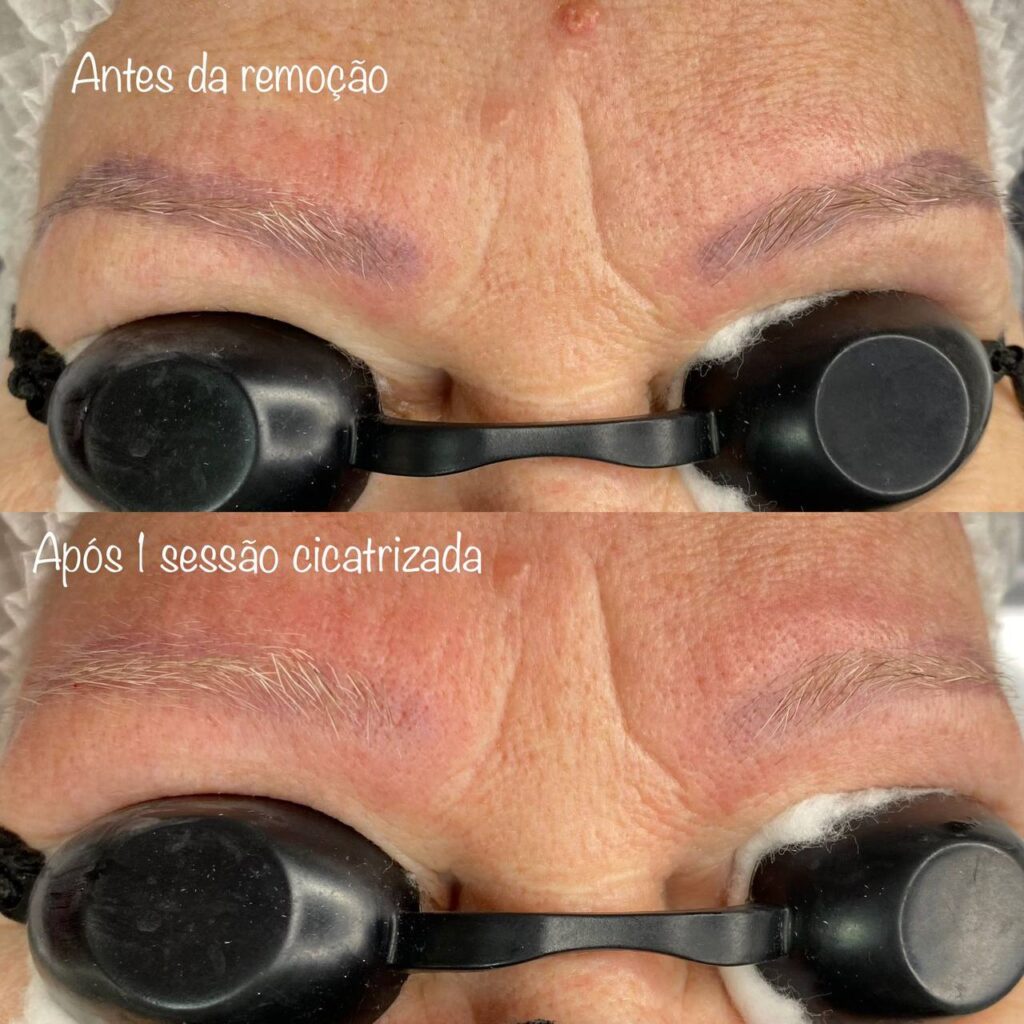 Remoção 02